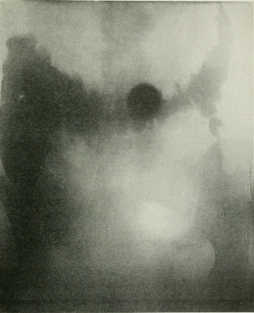 An illustration from X-rays, how to produce and interpret them, 1915, leaf 138