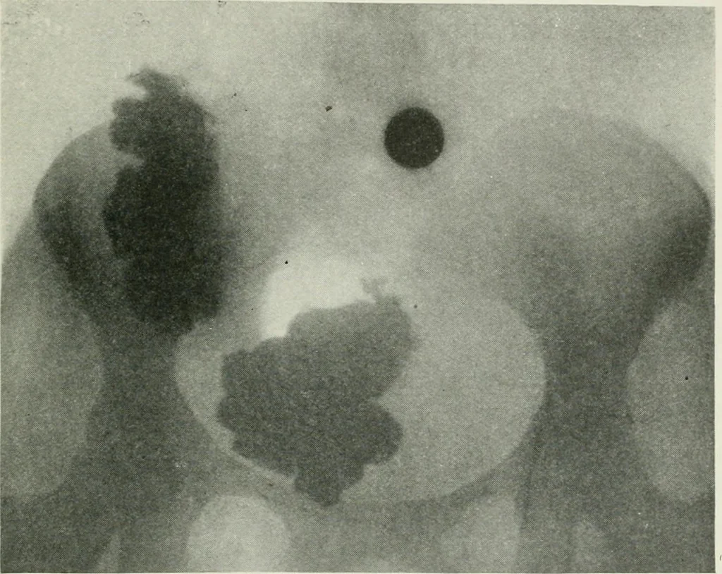 An illustration from X-rays, how to produce and interpret them, 1915, leaf 140