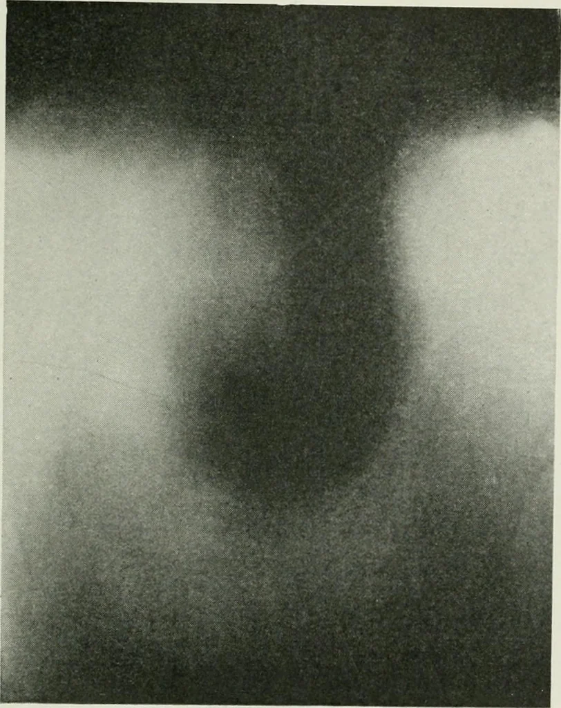 An illustration from X-rays, how to produce and interpret them, 1915, leaf 144