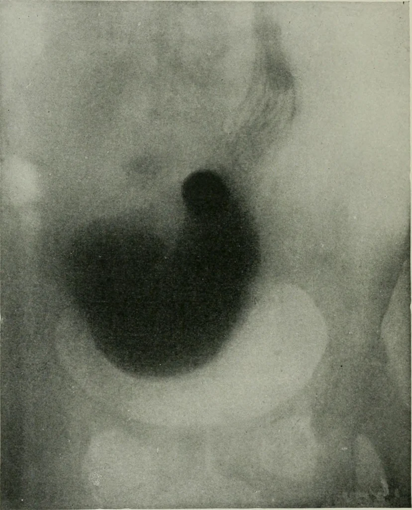 An illustration from X-rays, how to produce and interpret them, 1915, leaf 147