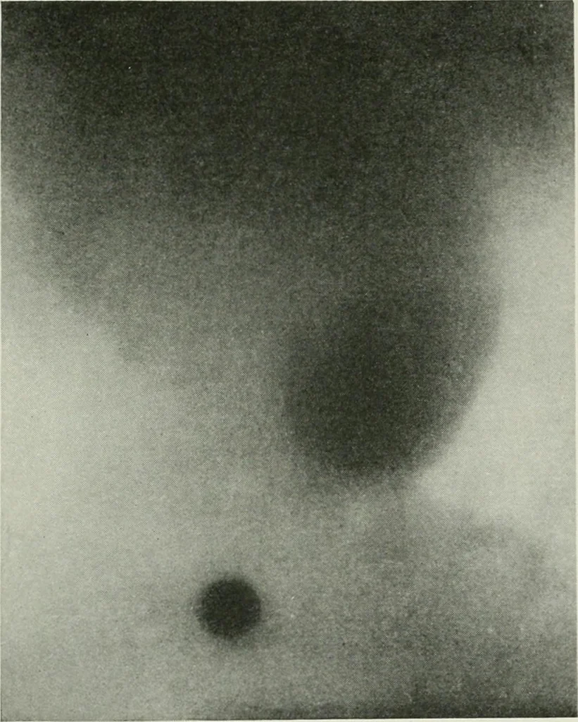 An illustration from X-rays, how to produce and interpret them, 1915, leaf 148