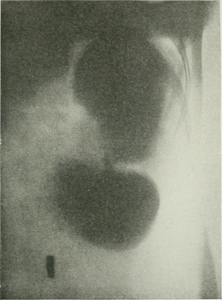 An illustration from X-rays, how to produce and interpret them, 1915, leaf 150
