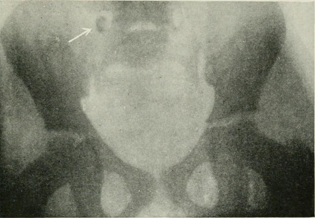 An illustration from X-rays, how to produce and interpret them, 1915, leaf 162