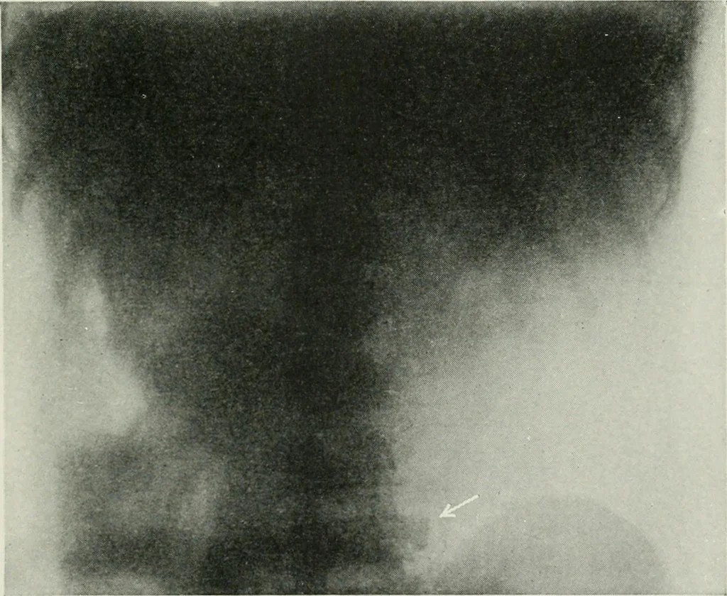 An illustration from X-rays, how to produce and interpret them, 1915, leaf 162