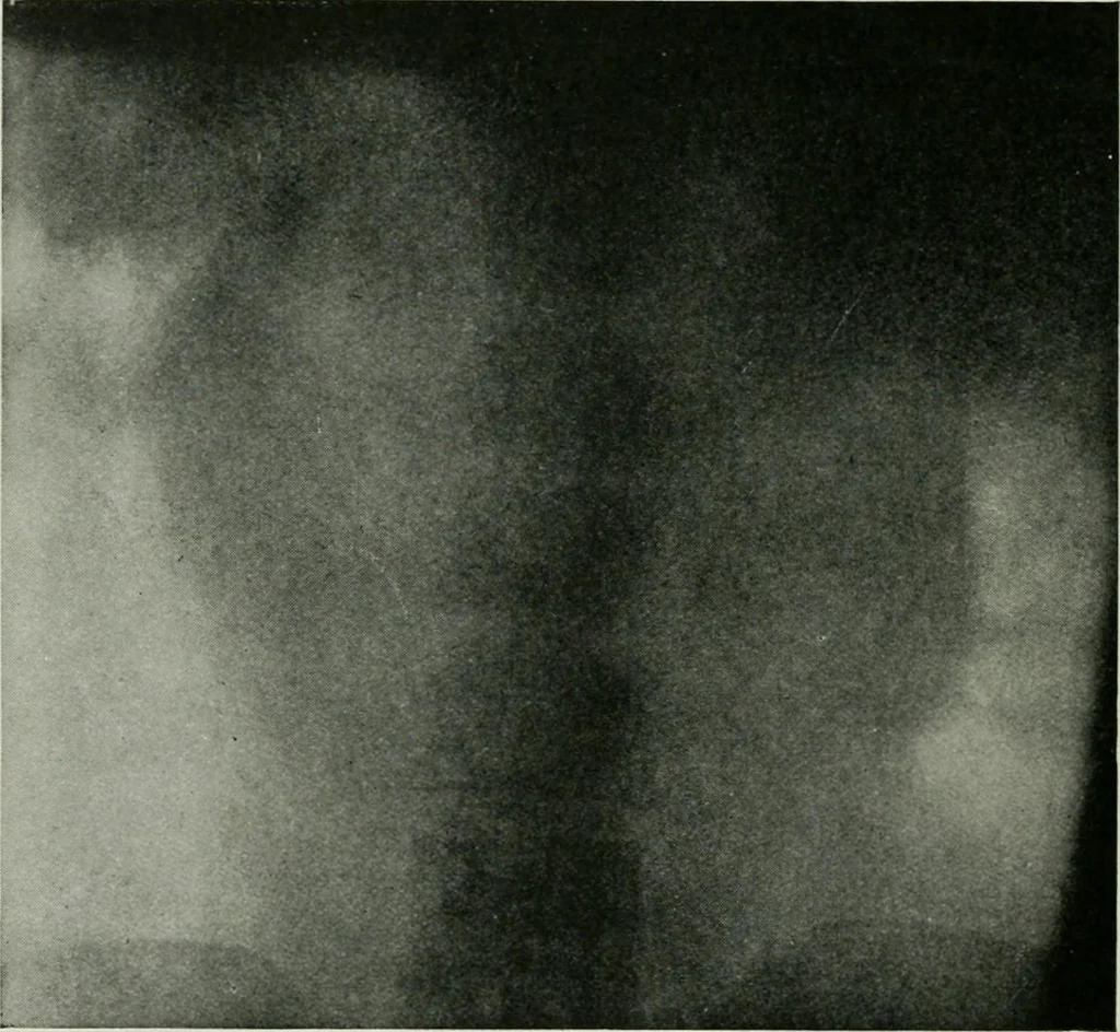 An illustration from X-rays, how to produce and interpret them, 1915, leaf 163
