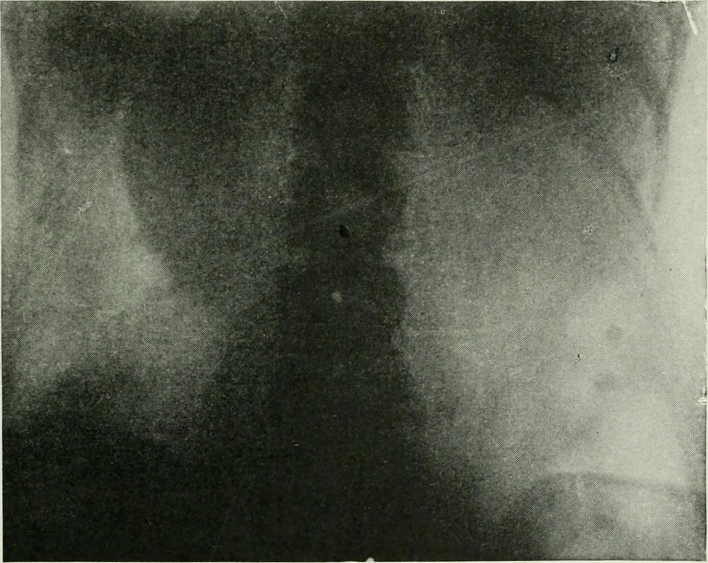 An illustration from X-rays, how to produce and interpret them, 1915, leaf 166