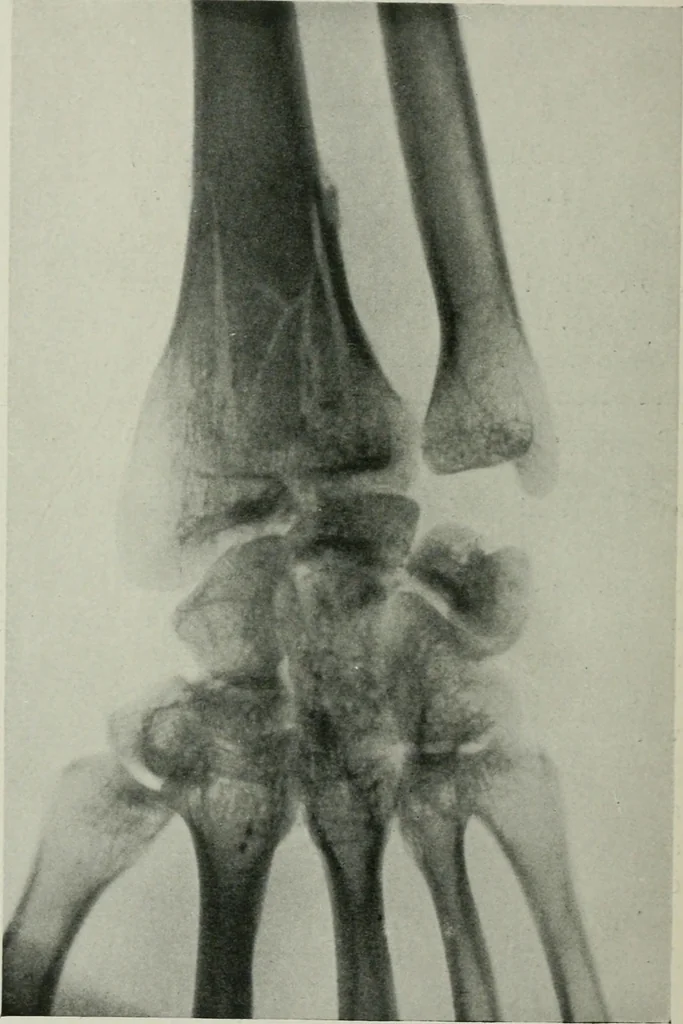 An illustration from X-rays, how to produce and interpret them, 1915, leaf 173