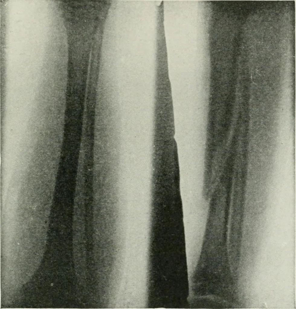 An illustration from X-rays, how to produce and interpret them, 1915, leaf 174