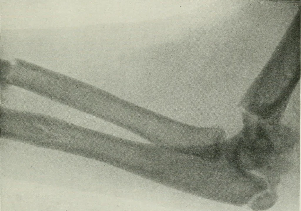 An illustration from X-rays, how to produce and interpret them, 1915, leaf 176