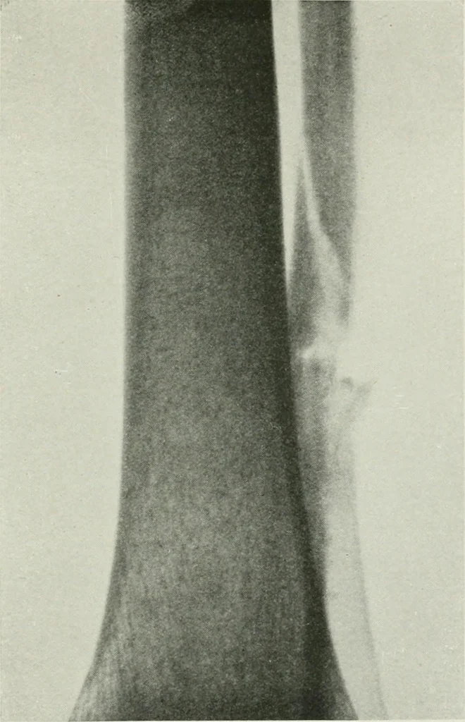 An illustration from X-rays, how to produce and interpret them, 1915, leaf 178