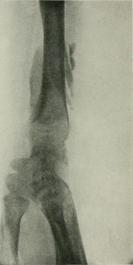An illustration from X-rays, how to produce and interpret them, 1915, leaf 179
