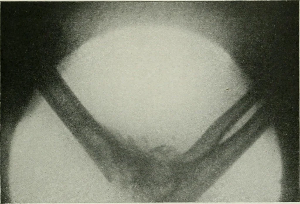 An illustration from X-rays, how to produce and interpret them, 1915, leaf 180