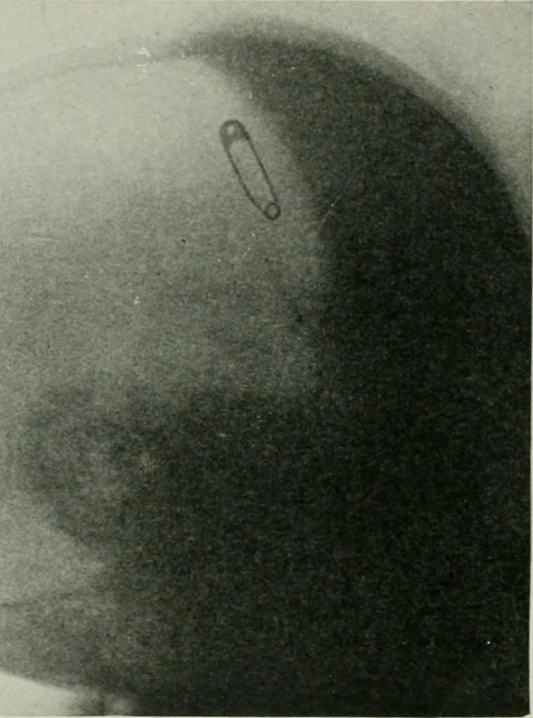 An illustration from X-rays, how to produce and interpret them, 1915, leaf 183