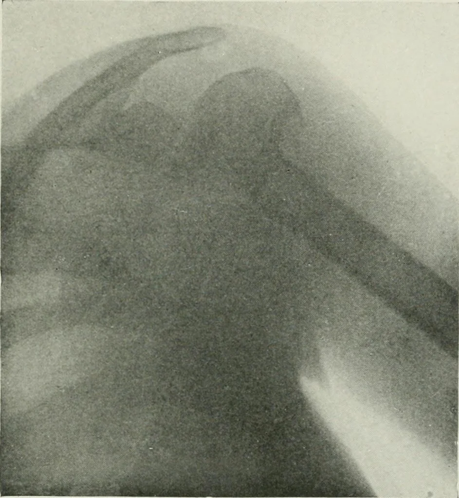 An illustration from X-rays, how to produce and interpret them, 1915, leaf 184
