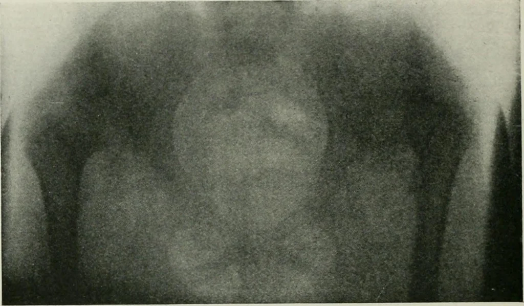 An illustration from X-rays, how to produce and interpret them, 1915, leaf 185