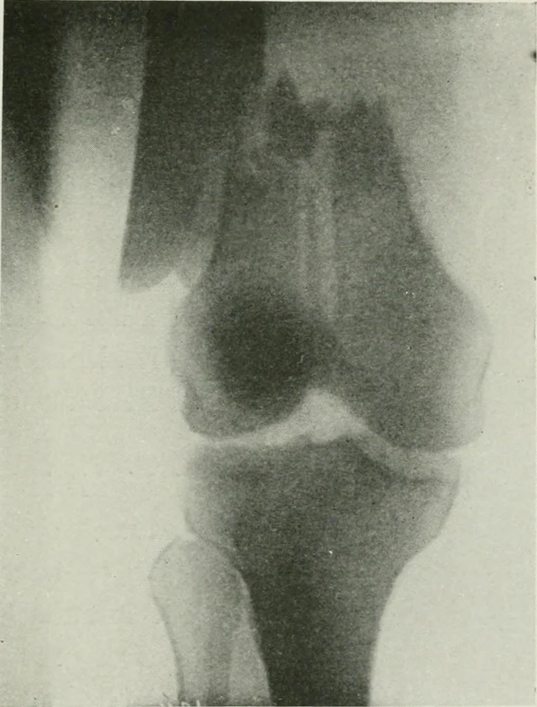 An illustration from X-rays, how to produce and interpret them, 1915, leaf 188