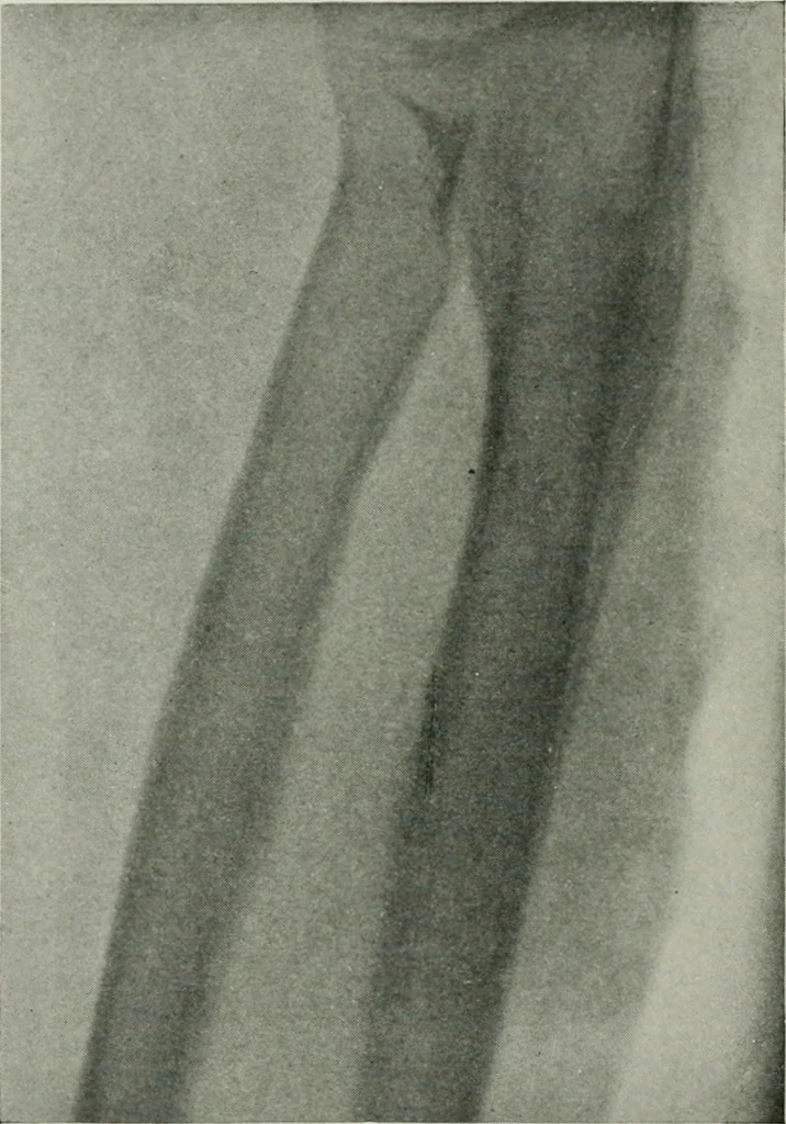 An illustration from X-rays, how to produce and interpret them, 1915, leaf 191