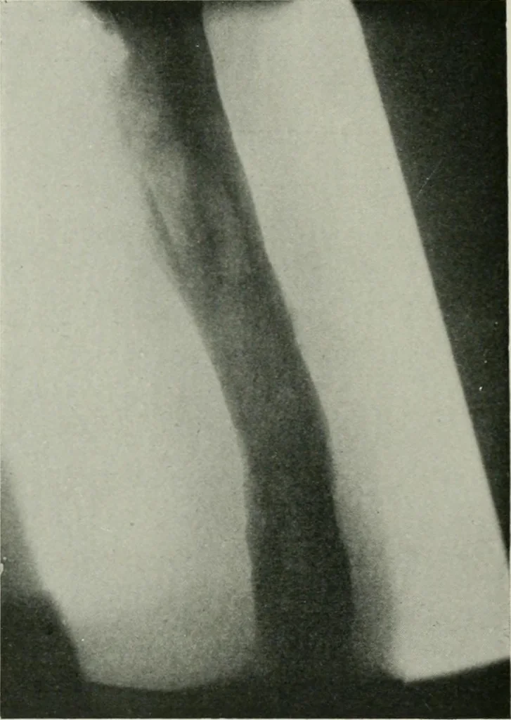 An illustration from X-rays, how to produce and interpret them, 1915, leaf 193