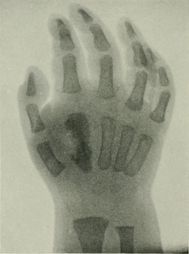 An illustration from X-rays, how to produce and interpret them, 1915, leaf 195