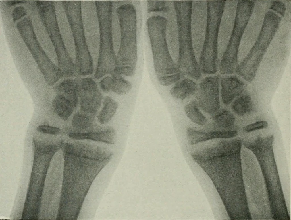 An illustration from X-rays, how to produce and interpret them, 1915, leaf 197
