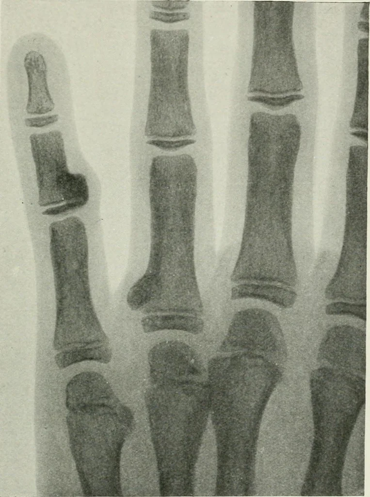 An illustration from X-rays, how to produce and interpret them, 1915, leaf 200