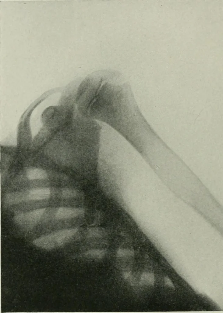 An illustration from X-rays, how to produce and interpret them, 1915, leaf 201