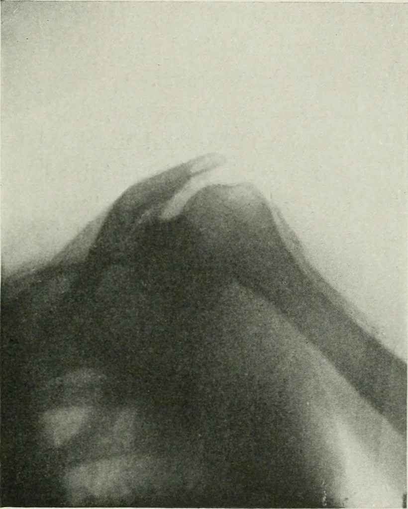 An illustration from X-rays, how to produce and interpret them, 1915, leaf 202