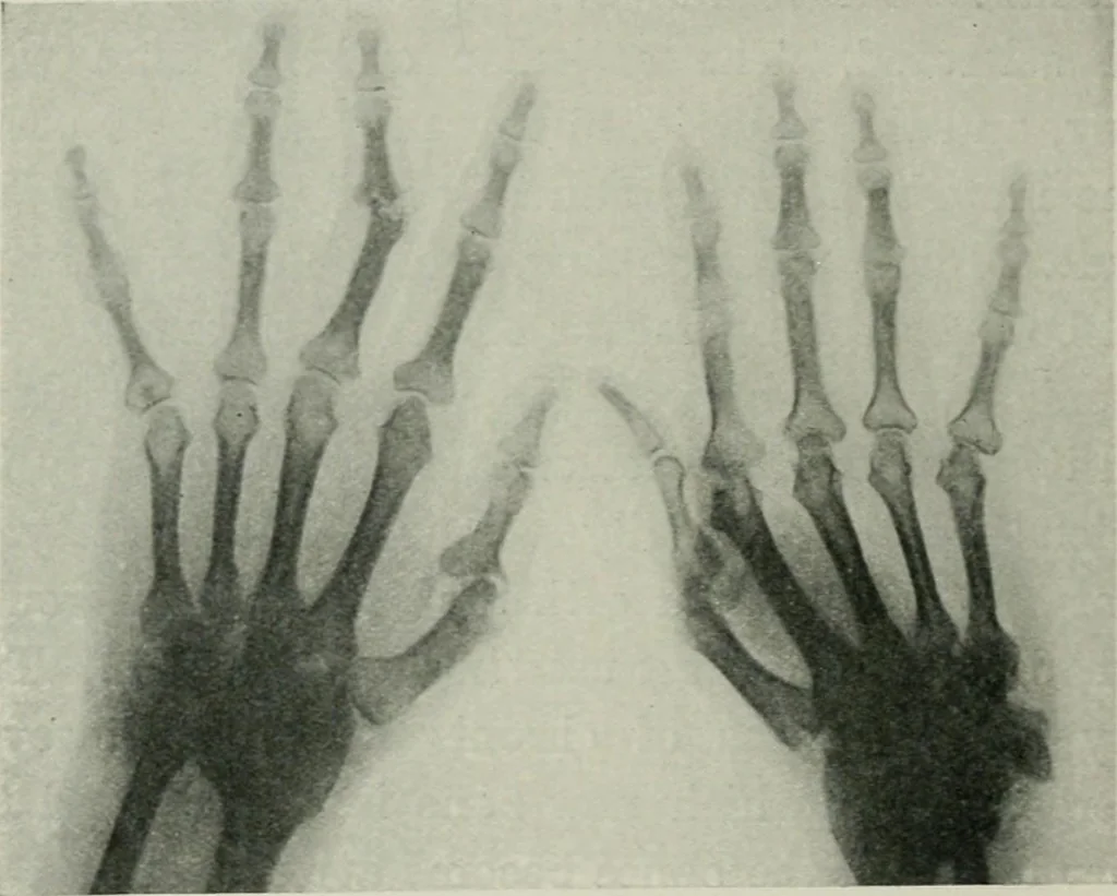 An illustration from X-rays, how to produce and interpret them, 1915, leaf 207