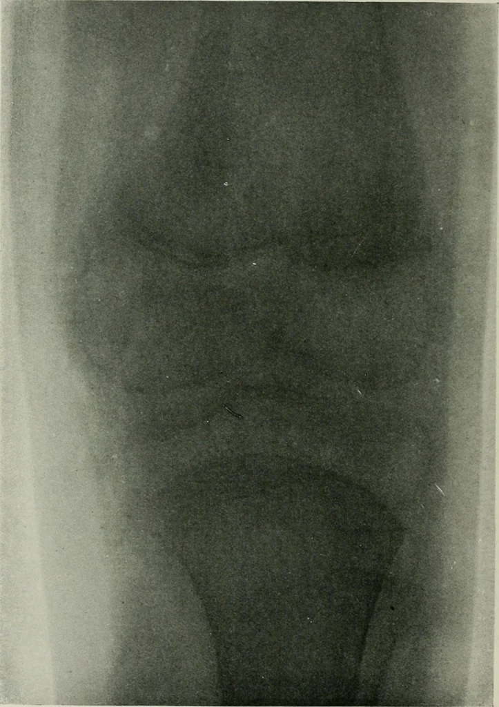 An illustration from X-rays, how to produce and interpret them, 1915, leaf 209