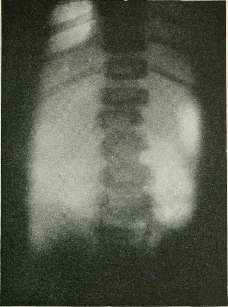 An illustration from X-rays, how to produce and interpret them, 1915, leaf 212