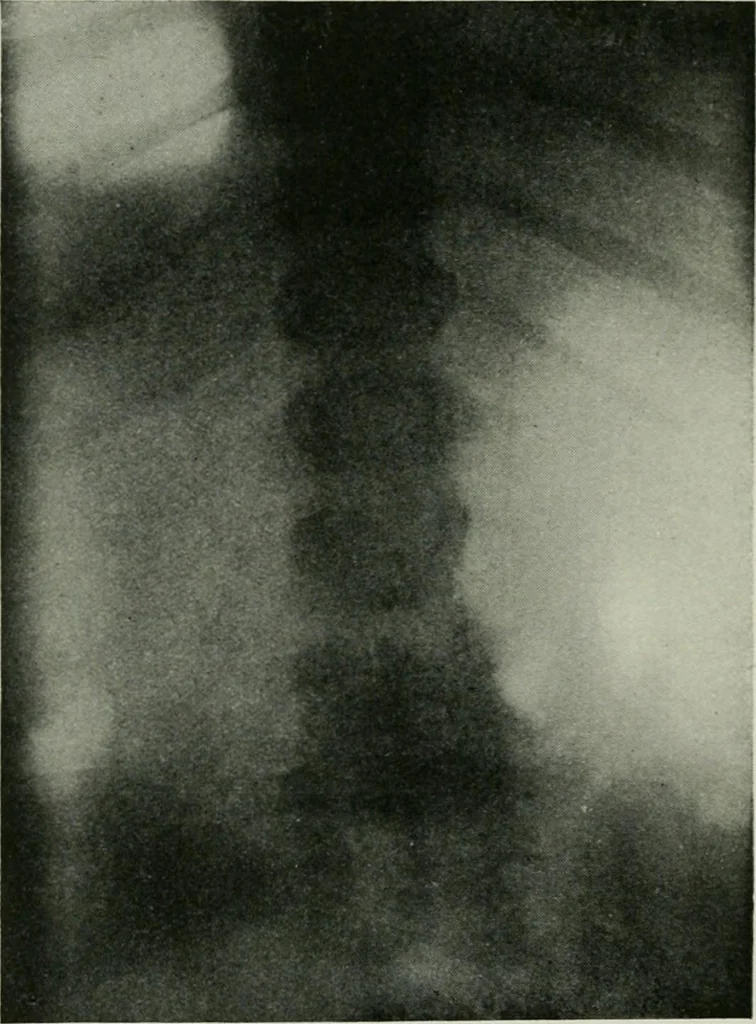 An illustration from X-rays, how to produce and interpret them, 1915, leaf 213