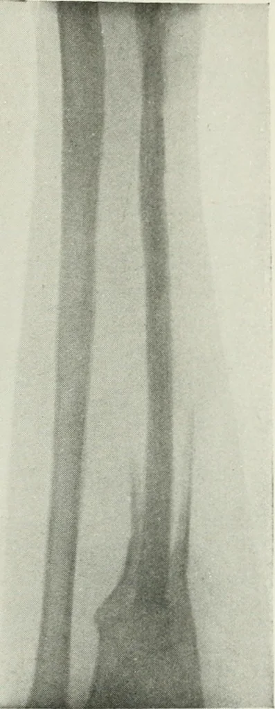 An illustration from X-rays, how to produce and interpret them, 1915, leaf 214