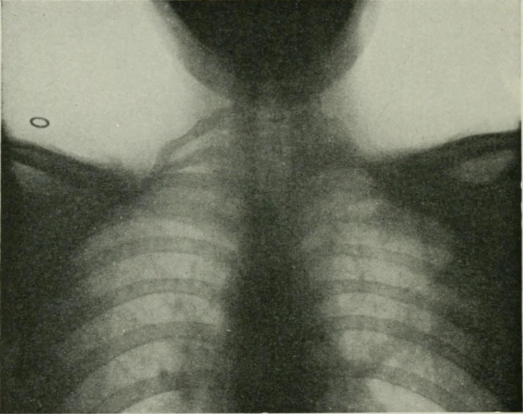 An illustration from X-rays, how to produce and interpret them, 1915, leaf 215