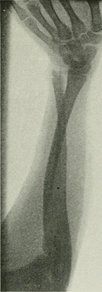 An illustration from X-rays, how to produce and interpret them, 1915, leaf 216