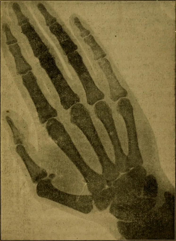 An illustration from X-rays simply explained : a handbook on the theory and practice of radiography, 1903, leaf 90