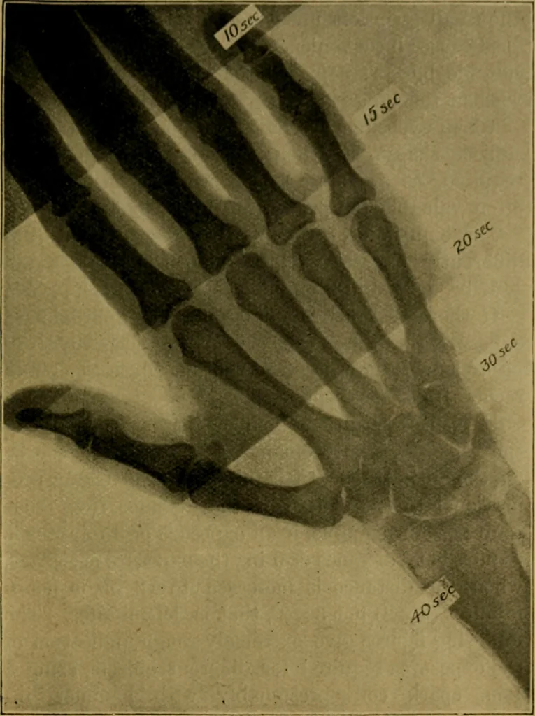An illustration from X-rays simply explained : a handbook on Röntgen rays in theory and practice, 1904, leaf 96