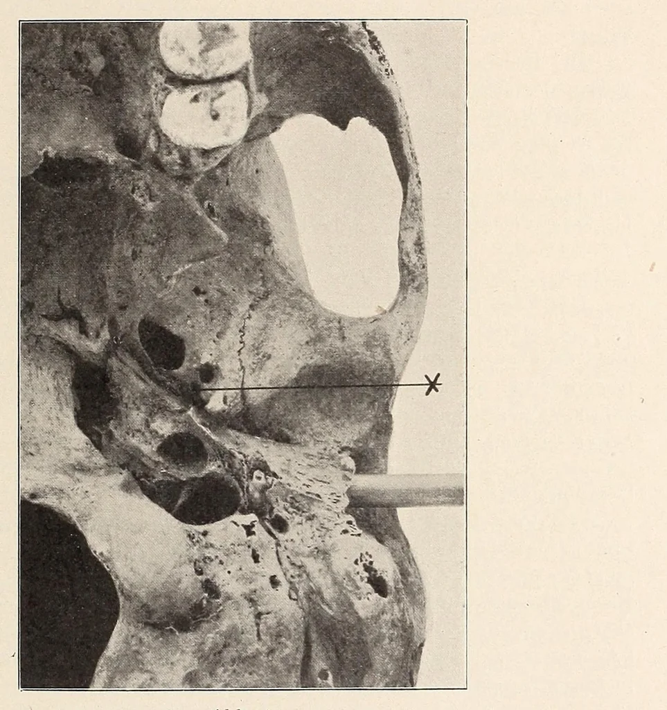 An illustration from Zur anthropologie des abflusslosen rumpfschollenlandes im nordöstlichen Deutsch-Ostrafrika, auf grund der sammlung der Ostrafrika- expedition (dr. E. Obst) der Geographischen gesellschaft in Hamburg, 1915, leaf 65