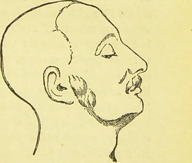 An illustration from The criminal / by Havelock Ellis., 1890, leaf 313