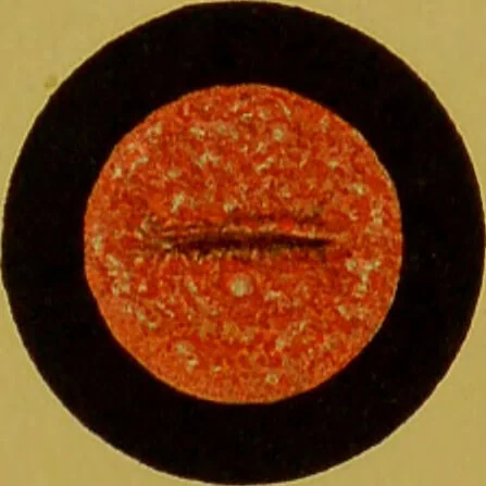 An illustration from Chronic urethritis and other affections of the genito-urinary organs : three lectures deivered at the Royal College of Surgeons in June 1889 / by Matthew Berkeley Hill., 1890, leaf 13