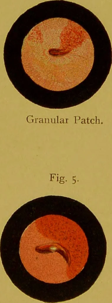 An illustration from Chronic urethritis and other affections of the genito-urinary organs : three lectures deivered at the Royal College of Surgeons in June 1889 / by Matthew Berkeley Hill., 1890, leaf 13