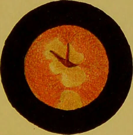An illustration from Chronic urethritis and other affections of the genito-urinary organs : three lectures deivered at the Royal College of Surgeons in June 1889 / by Matthew Berkeley Hill., 1890, leaf 19