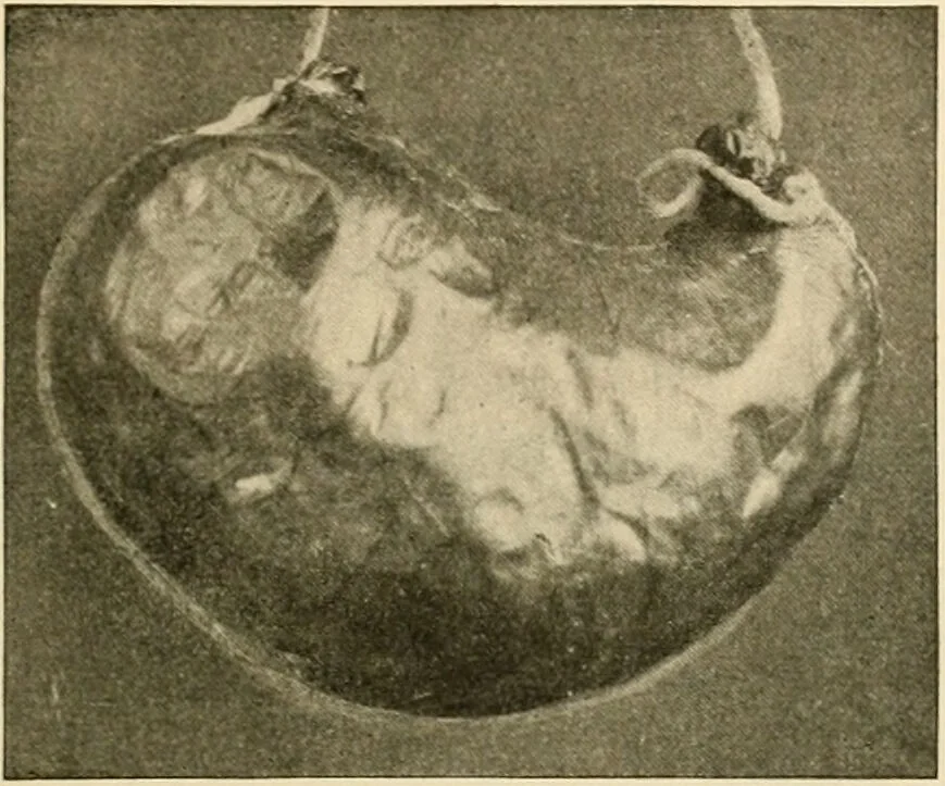 An illustration from Pediatrics : the hygienic and medical treatment of children / by Thomas Morgan Rotch., 1898, leaf 101