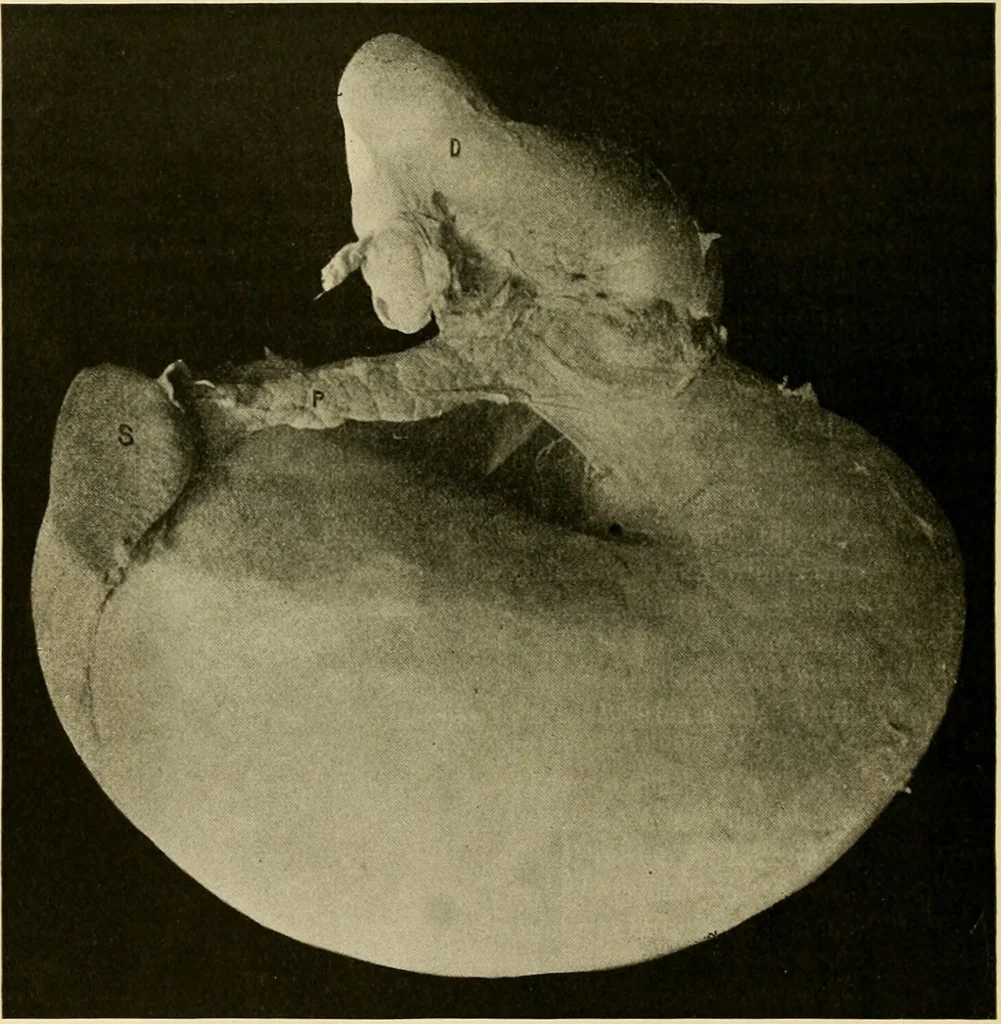An illustration from Pediatrics : the hygienic and medical treatment of children / by Thomas Morgan Rotch., 1898, leaf 102