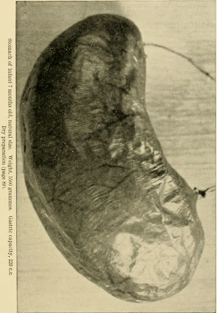 An illustration from Pediatrics : the hygienic and medical treatment of children / by Thomas Morgan Rotch., 1898, leaf 105