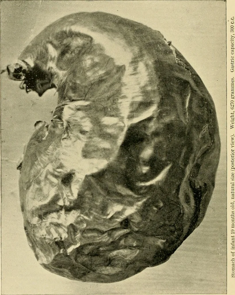 An illustration from Pediatrics : the hygienic and medical treatment of children / by Thomas Morgan Rotch., 1898, leaf 106