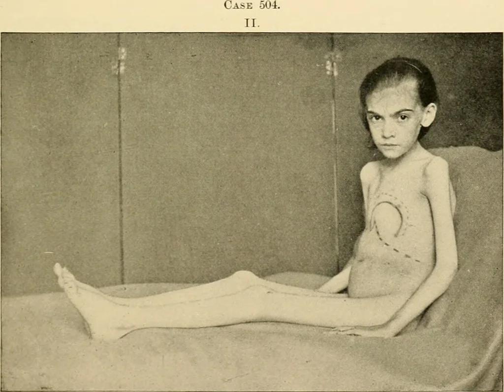 An illustration from Pediatrics : the hygienic and medical treatment of children / by Thomas Morgan Rotch., 1898, leaf 1127