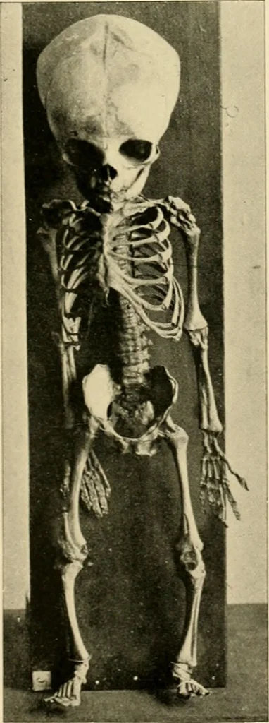 An illustration from Pediatrics : the hygienic and medical treatment of children / by Thomas Morgan Rotch., 1898, leaf 141