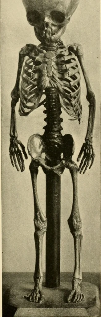 An illustration from Pediatrics : the hygienic and medical treatment of children / by Thomas Morgan Rotch., 1898, leaf 141