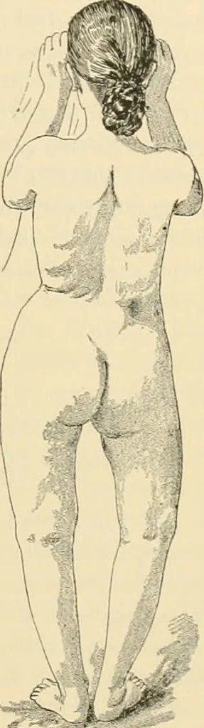 An illustration from Pediatrics : the hygienic and medical treatment of children / by Thomas Morgan Rotch., 1898, leaf 173