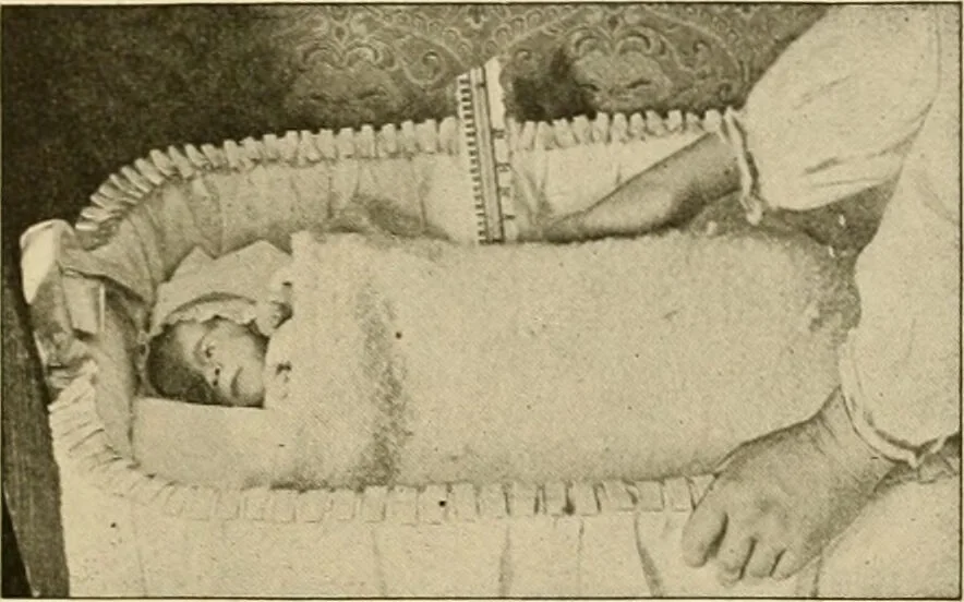 An illustration from Pediatrics : the hygienic and medical treatment of children / by Thomas Morgan Rotch., 1898, leaf 339